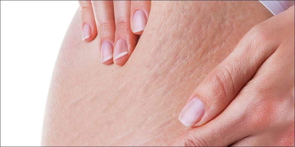 cara ampuh atasi stretch mark di tubuh