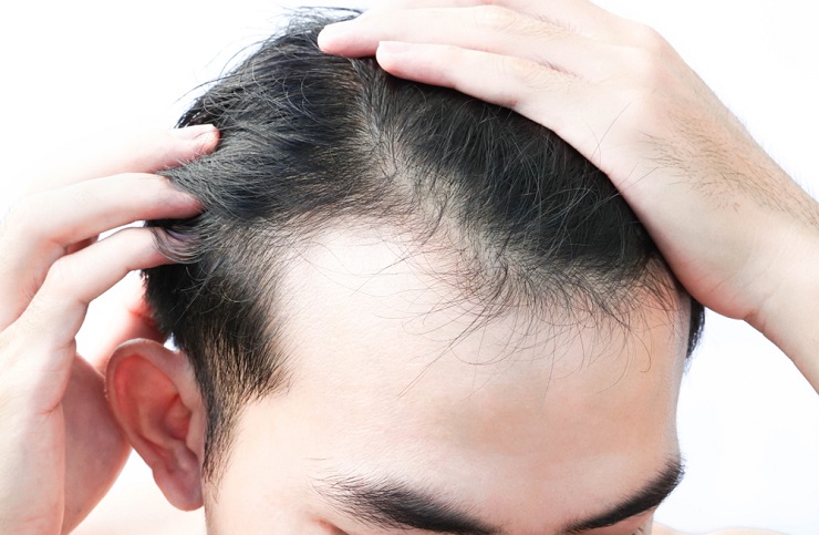 Cara mencegah dan mengatasi rambut rontok