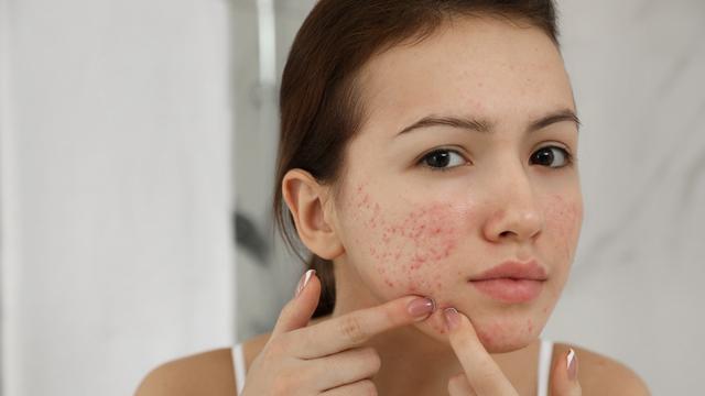 kenali skin purging dan cara mengatasinya