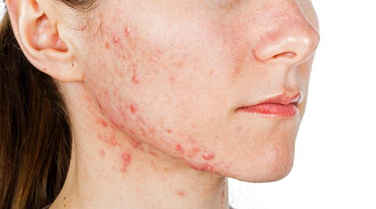 arti acne prone dan cara mengatasinya