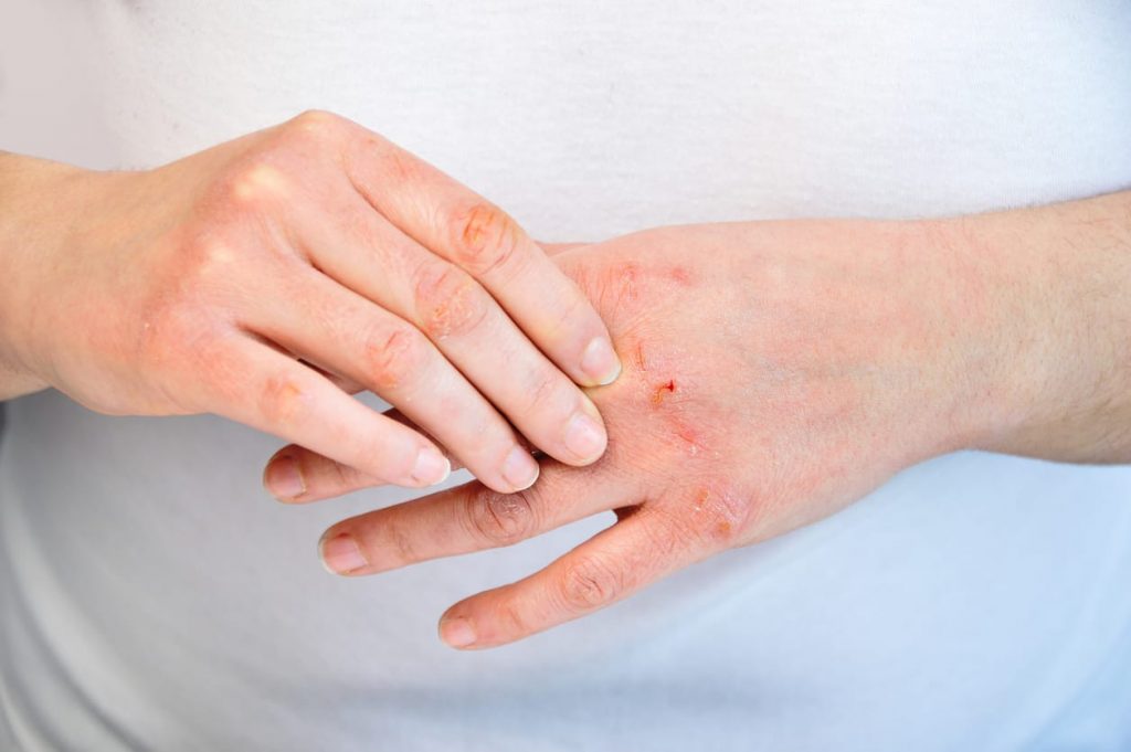 Gejala Scabies Yang Perlu Di Ketahui Batrisyia Herbal