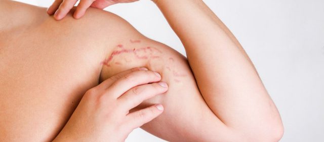 Cara Mengatasi Stretch Mark Secara Alami