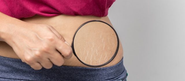 Apa Penyebab Stretch Mark?