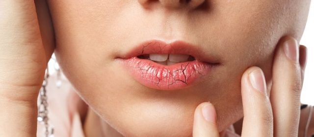 Penyebab dan Cara Mengatasi Bibir Kering